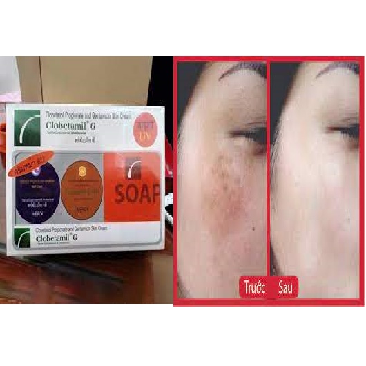 KEM TRỊ TÀN NHANG VÀ NÁM TRẮNG DA THÁI LAN - SÉT NÁM CAO CẤP THÁI LAN