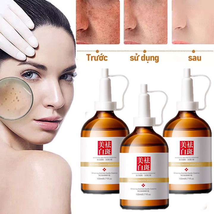 Tinh chất làm trắng sạch tàn nhang 100ml Kem trắng da và xóa tàn nhang, Hiệu quả làm mờ thâm nám tàn nhan, kem thâm nám