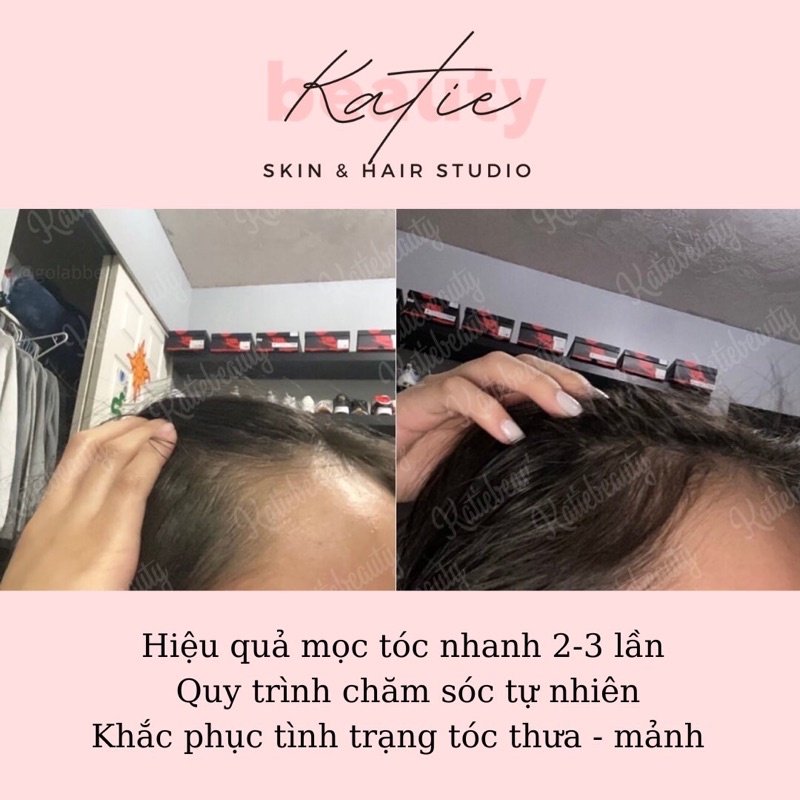 Xịt kích mọc tóc men vi sinh HAIR TREATMENT SPRAY 120ml | KATIEBEAUTY