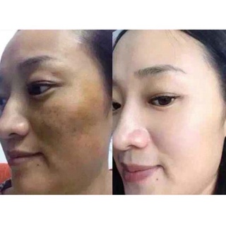 Viên Uống Trắng Da Mờ Nám Giảm Nếp Nhăn Glutathione 1000mg