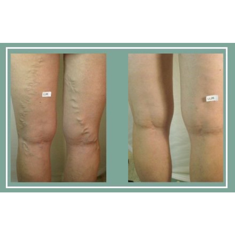 Kem Varikosette giảm giãn tĩnh mạch Nga