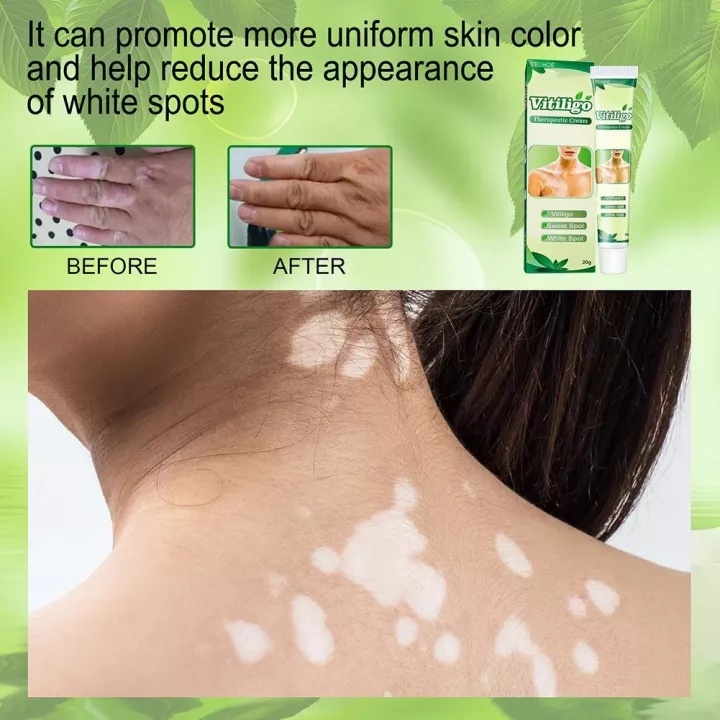 Thảo dược bôi bạch biến/20g