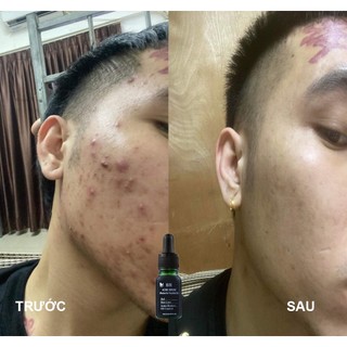 Serum giảm mụn mờ thâm BH 10ml