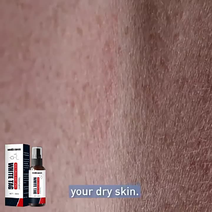 Kem vitiligo Kem vitiligo Loại Bỏ vitiligo Hỗ Trợ Giảm vitiligo