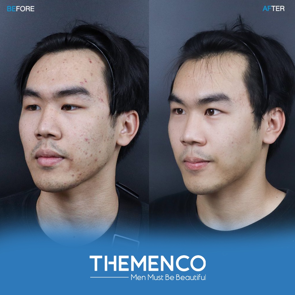 Tinh Chất Chấm Mụn Giúp Làm Khô Nhân Mụn,Làm Xẹp Mụn Viêm, Trứng Cá Và Mụn Đầu Đen The Menco Zinc White Acne 10ml