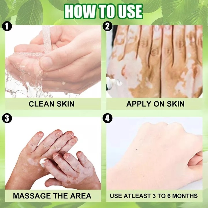 Thảo dược bôi bạch biến/20g