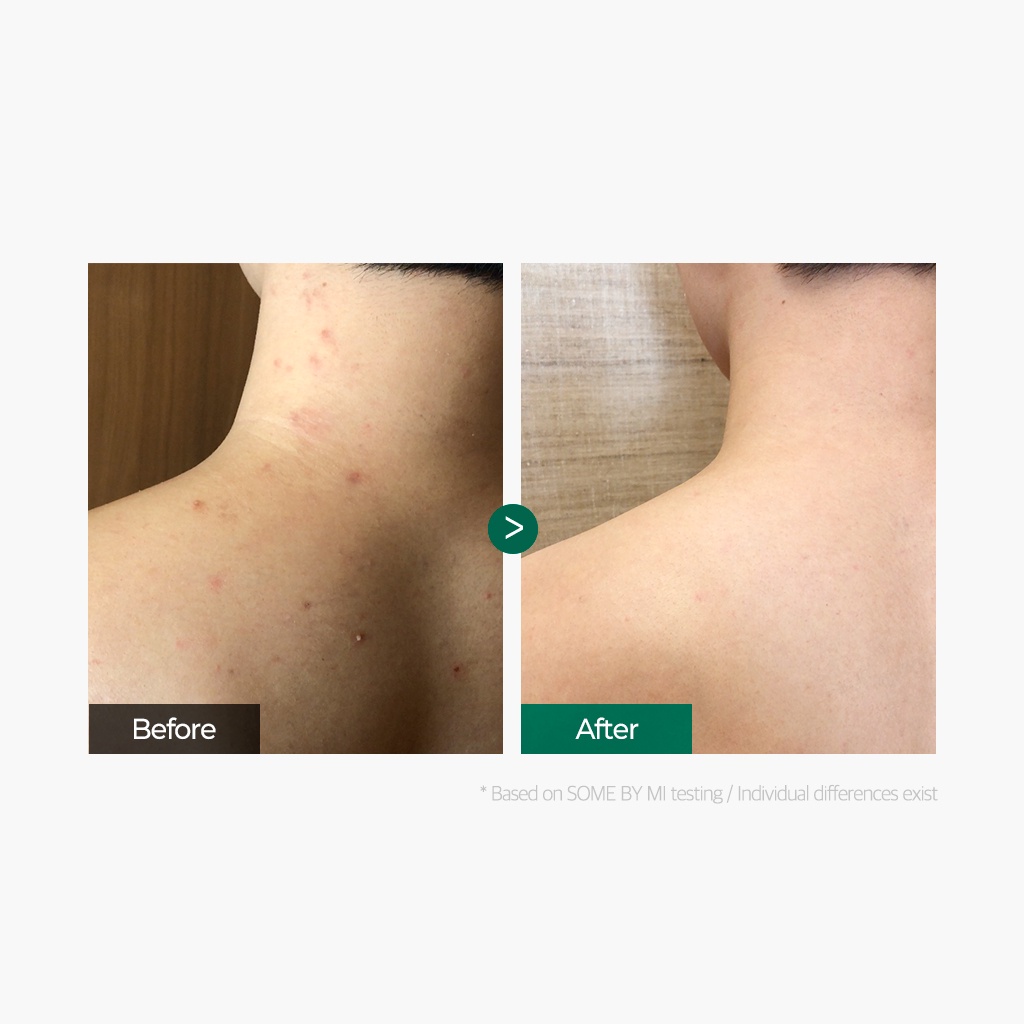 Sữa Tắm Some By Mi AHA-BHA-PHA 30 Days Miracle Acne Clear Body Cleanser 400g - Giảm Mụn Lưng, Dày Sừng Nang Lông