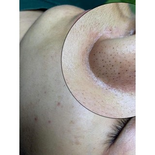 SERUM CHẤM MỤN  DƯỠNG DA HANDMADE