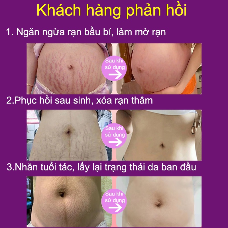 Kem rạn da Kem rạn da sau sinh Kem xoá rạn da sau sinh 60g ngăn ngừa rạn da  cải thiện sẹo lâu năm phục hồi da dưỡng ẩm