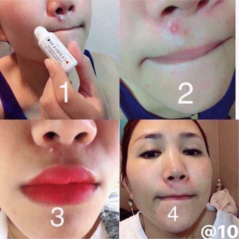 Cây Chấm mụn CLINDA-M 15G THÁI LAN