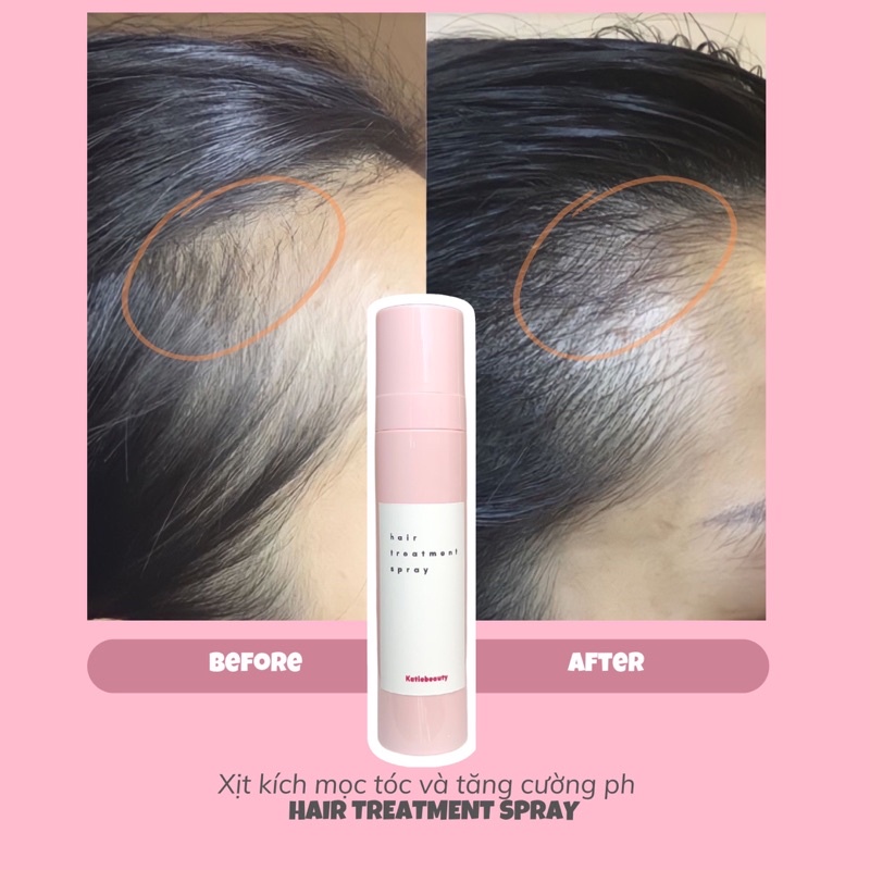 Xịt kích mọc tóc men vi sinh HAIR TREATMENT SPRAY 120ml | KATIEBEAUTY