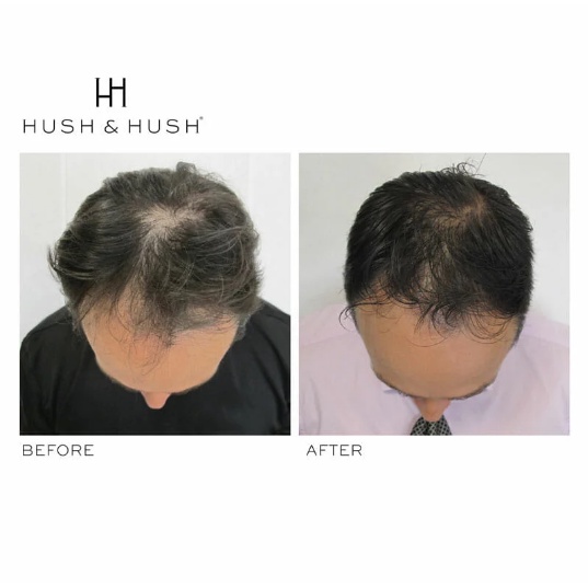 Viên uống mọc tóc, phục hồi tóc gãy rụng Hush & Hush Deeply Rooted 120 viên