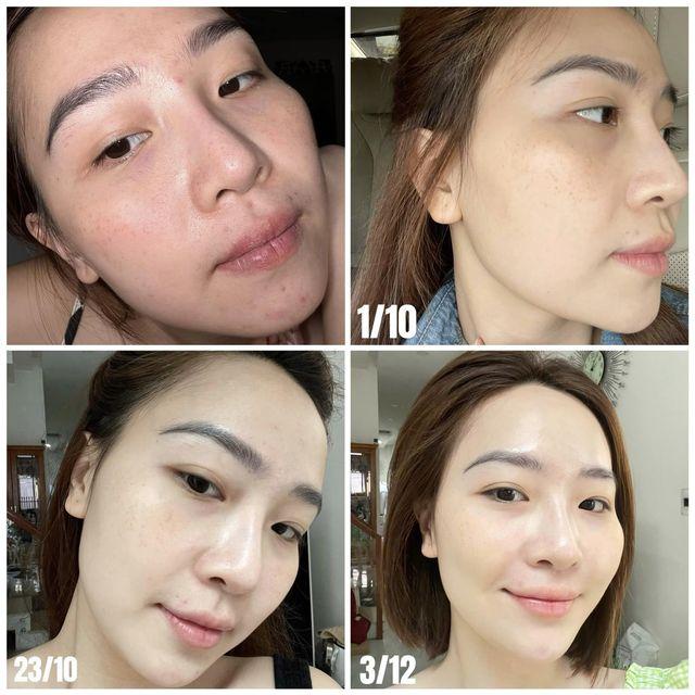Serum Botox Dưỡng Da LAMIC
