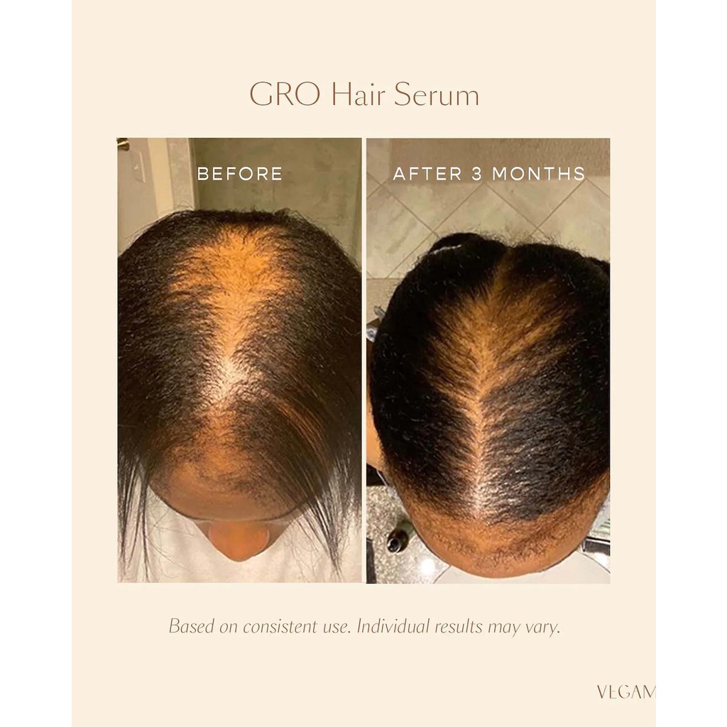 Serum, Gội - Xả kích thích mọc tóc Vegamour