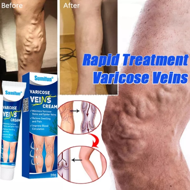 (HCM)Kem suy giãn tĩnh mạch giúp giảm đau mỏi, mất thẩm mỹ do suy giãn tĩnh mạch gây ra, cam kết hàng chuẩn 100%