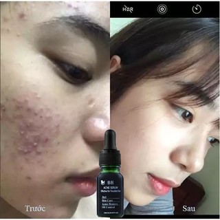 Serum giảm mụn mờ thâm BH 10ml