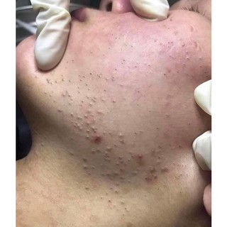 SERUM CHẤM MỤN  DƯỠNG DA HANDMADE