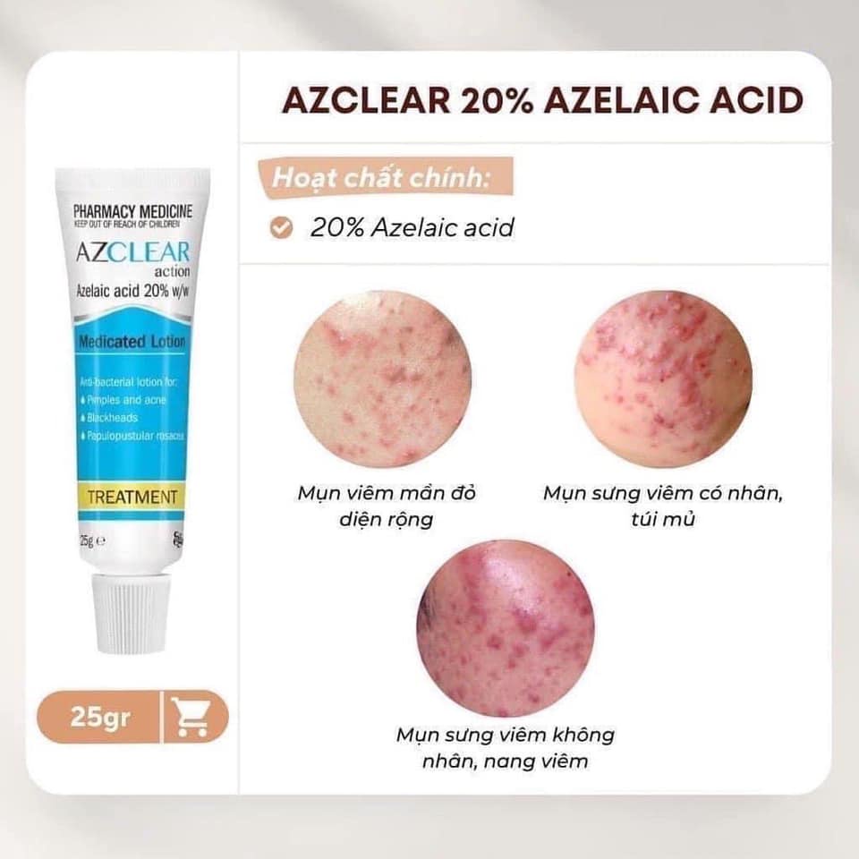 Kem Giảm Mụn Azclear Action Medicated Treatment Lotion Azelaic Acid 20% 25g