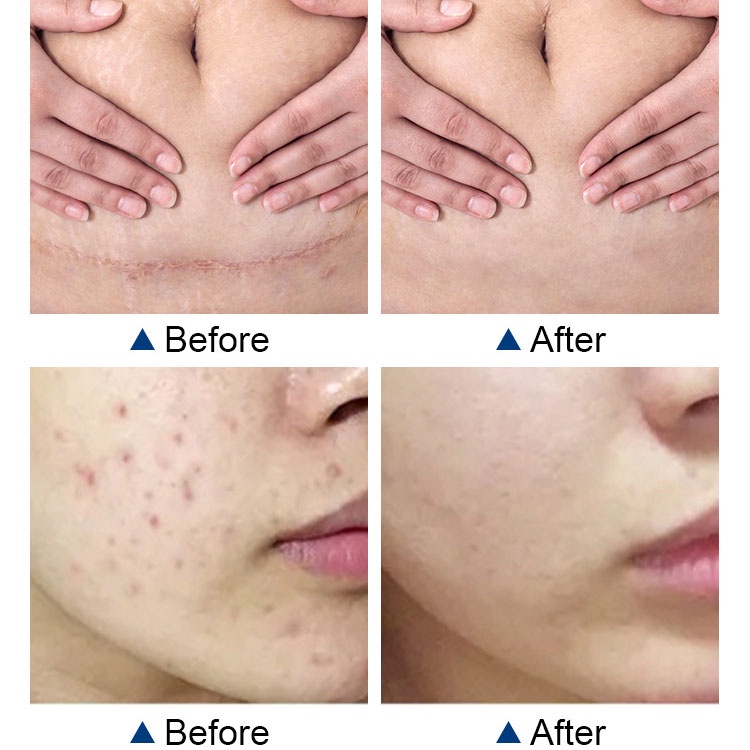 Kem xóa sẹo MOOYAM Scar removing cream 30g Trị sẹo lõm trị sẹo lâu năm