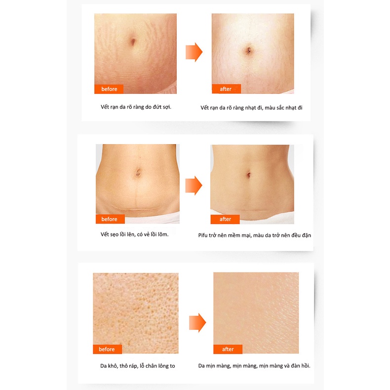 【💯Genuine Goods] QEM Stretch Marks Cream 100ml Prevention For Pregnant Women, Overcoming Stretch Marks