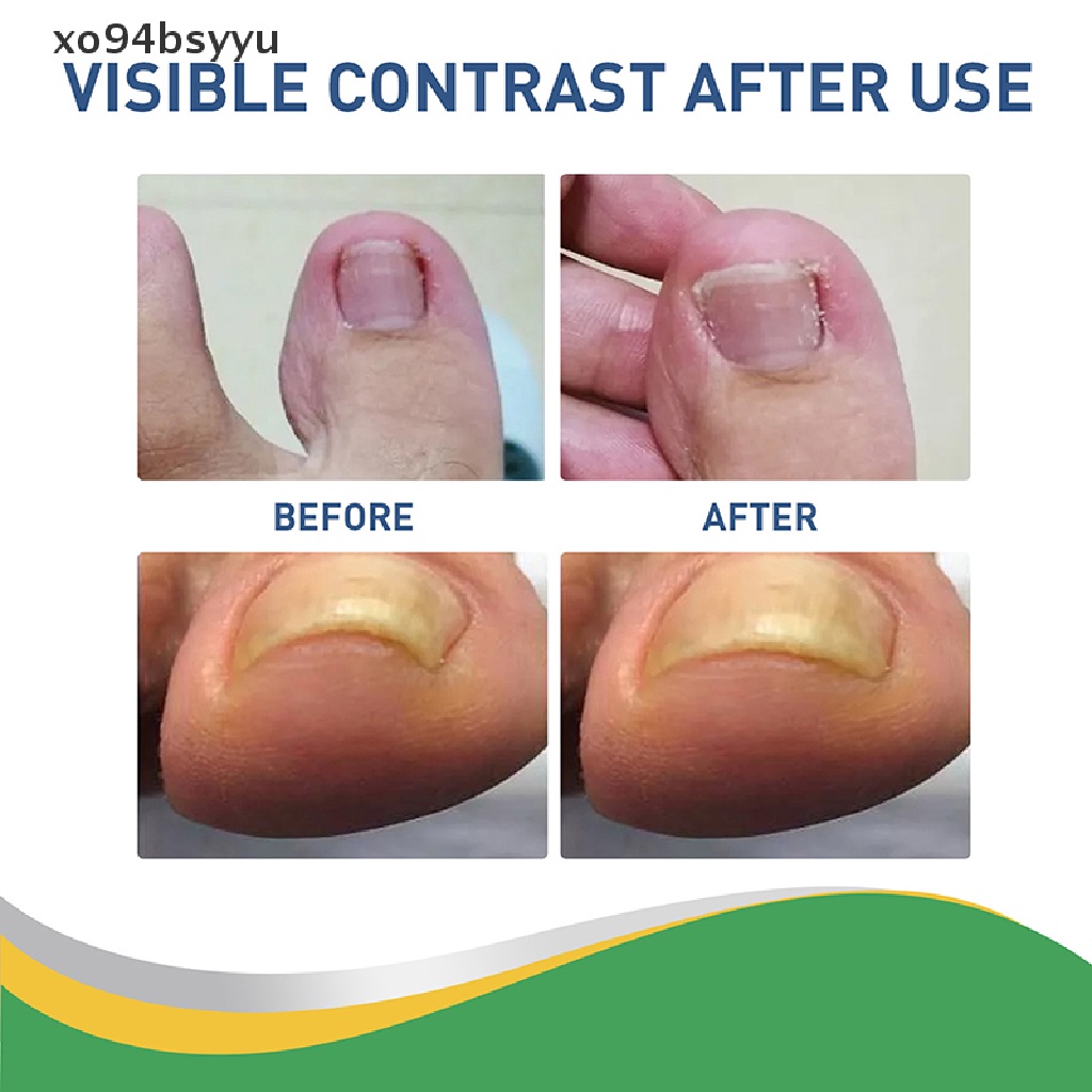 Set 50 Miếng Dán Chỉnh Sửa Móng Chân Xo94Bsyu Tiện Dụng