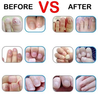 Bút Thảo Dược Trị Bệnh Nấm Móng Chăm Sóc Móng