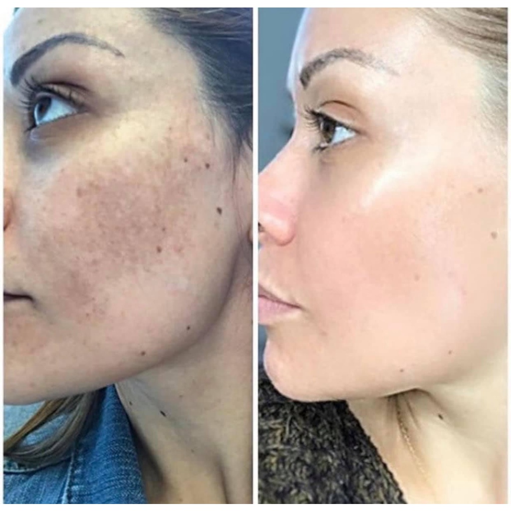 Kem nám Cosmelan 2 Chuyên nám mảng nám chân sâu ,đốm nâu tàn nhang , da không đều màu