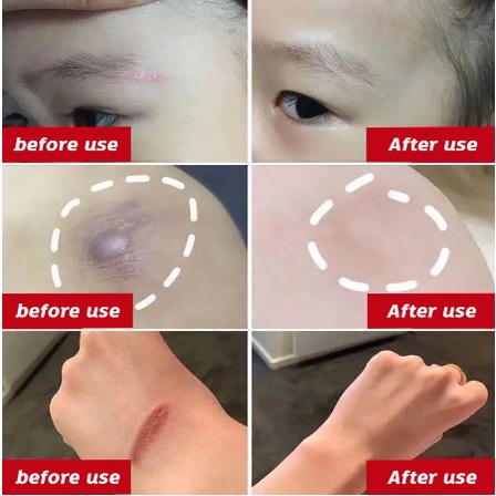 Kem sẹo phẫu thuật - Gel bôi sẹo lồi lõm lâu năm Scar giảm rạn hiệu quả 20ml