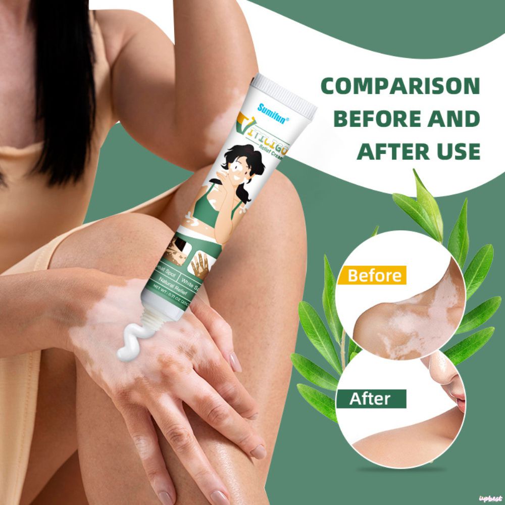 ♕Sumifun Kem Kháng Khuẩn Bạch Biến Kem Dưỡng Thể Phục Hồi Vết Trắng Thâm Nhập Sâu Vào Da Chăm Sóc Cơ Thể Chăm Sóc Da 20G Upbest