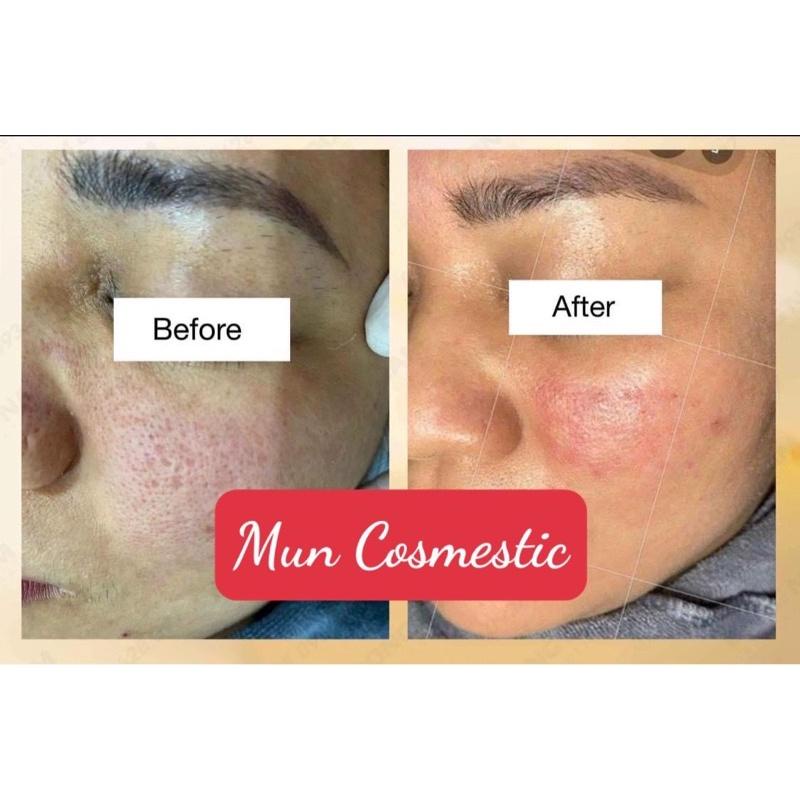 Hoạt Chất Peel Da T.C.AGE Innoaesthetic- Dành cho da sẹo rỗ, Lão Hoá, Sần Sùi, Dày Sừng