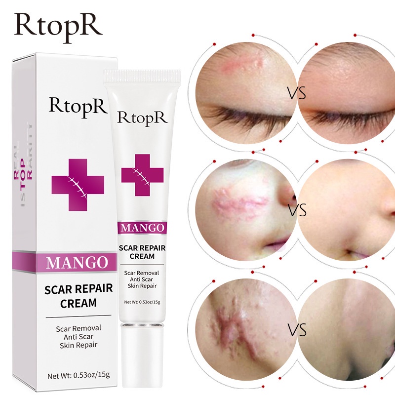 【💯Hàng thật】Kem xóa sẹo RtopR mango scar repair cream 15g Xóa và sửa sẹo trên mặt，cơ thể, vết bỏng ở trẻ em,  phụ nữ sau sinh mổ