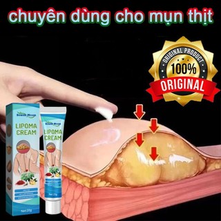 Kem tan mỡ chính hãng cho nhiều cục u dưới da đơn lẻ, u tuyến giáp, u mỡ dưới da dạng sợi