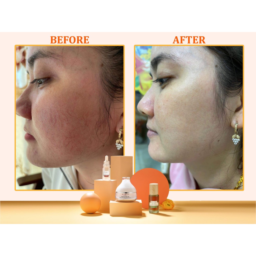 [Hàng có sẵn] Combo Hemo Almonds Cho Da Giãn Mao Mạch, Nám Máu