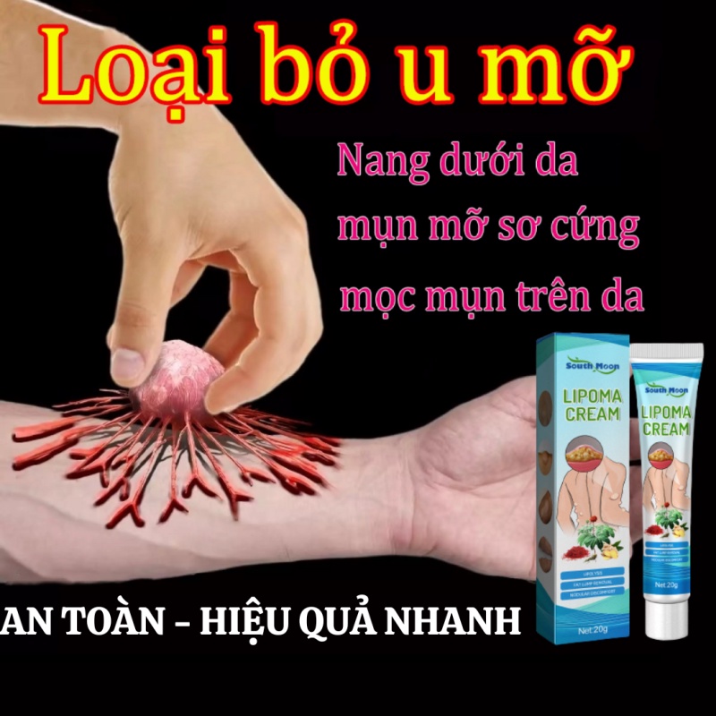 South Moon Kem Loại Bỏ Lipoma Lipolysis Kem tan u mỡ loại bỏ u mỡ hiệu quả kem loại bỏ u sưng phù sơ vữa đến 99% tinh ch