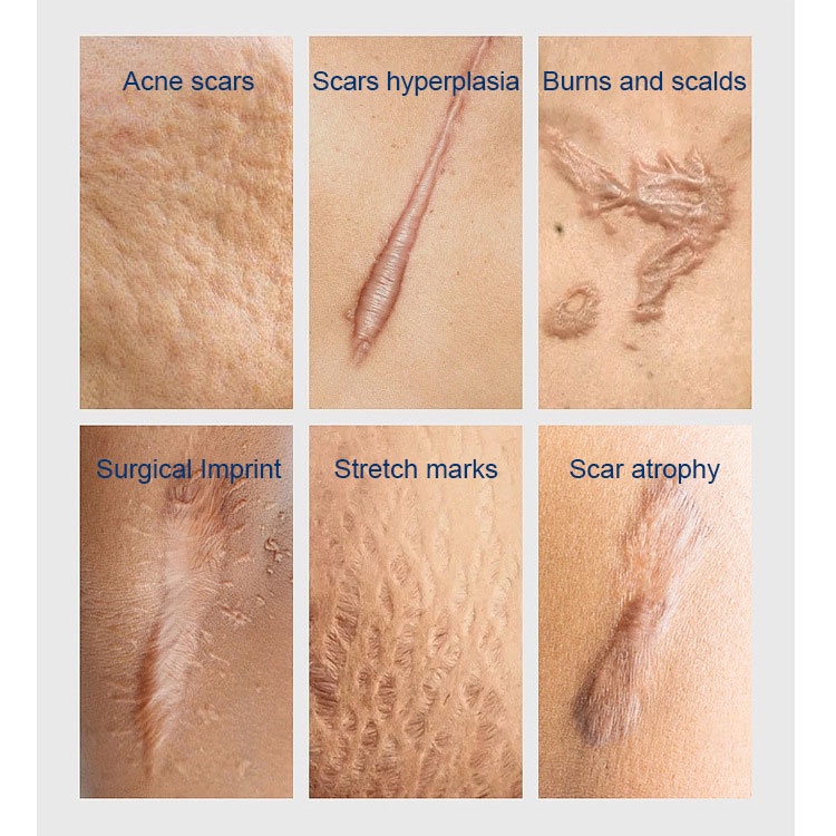 Kem xóa sẹo MOOYAM Scar removing cream 30g Trị sẹo lõm trị sẹo lâu năm