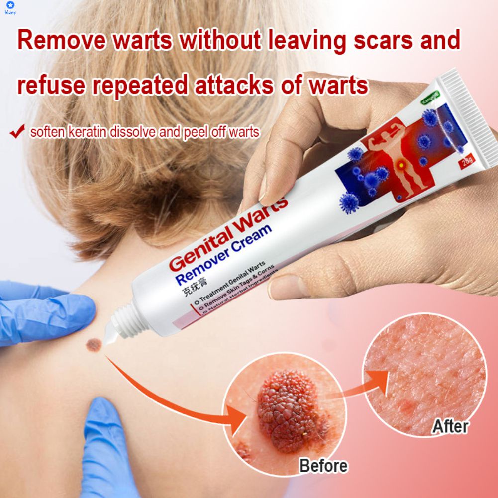 Thuốc Loại Bỏ Mụn Cóc Mụn Rộp Sinh Dục Thuốc Mỡ Loại Bỏ Mụn Cóc Nốt Ruồi & U Nhú Kem Điều Trị Condyloma Acuminatum [Bluey】