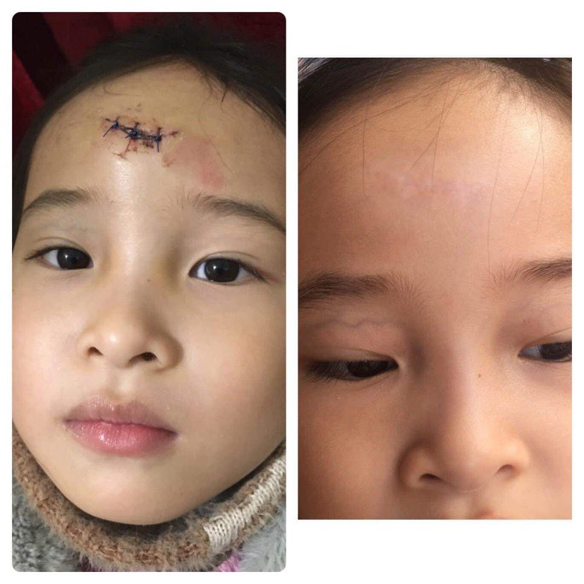 Kem sẹo phẫu thuật - Gel bôi sẹo lồi lõm lâu năm Scar giảm rạn hiệu quả 20ml