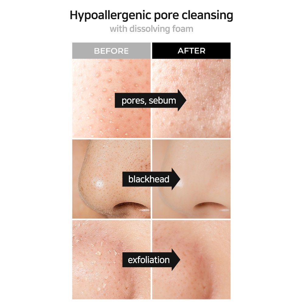 Set 5 Mặt Nạ Lột Mụn Đầu Đen Bong Bóng 3ml