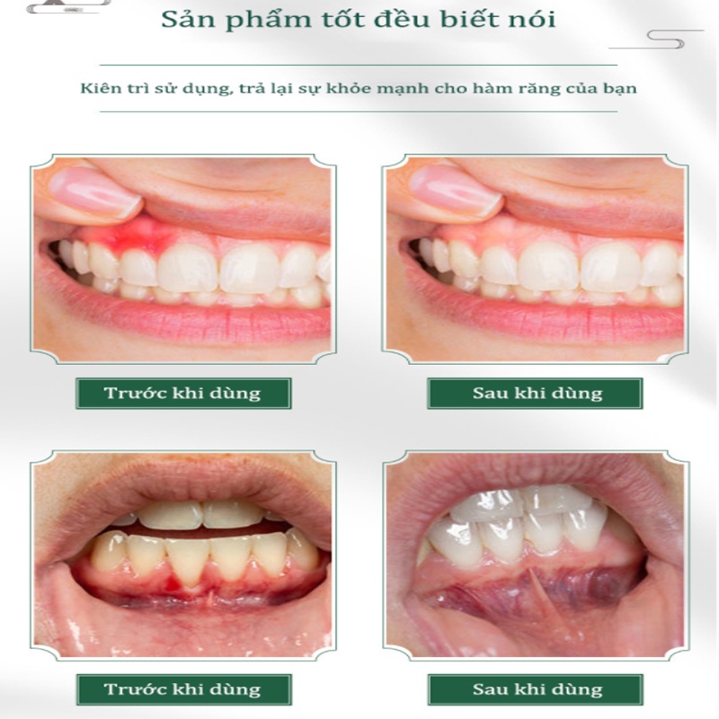 Xịt đau răng chai xịt giảm đau răng ê buốt giảm đau nhức nhanh chóng ngăn - ảnh sản phẩm 3