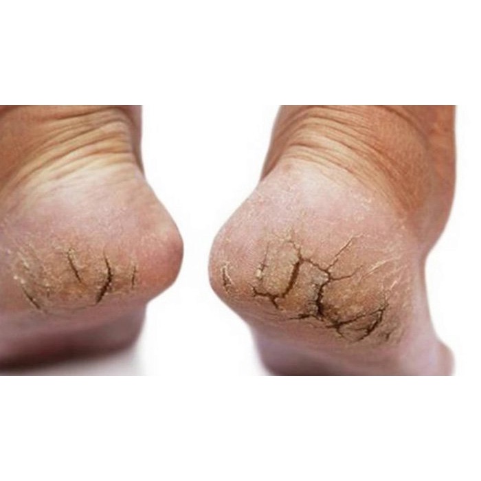 [Chính hãng] Kem bôi ngoài da chống nứt nẻ, nứt gót chân tay, á s.ừng, bong tróc khô da cực hiệu quả, tuýp 15Gr