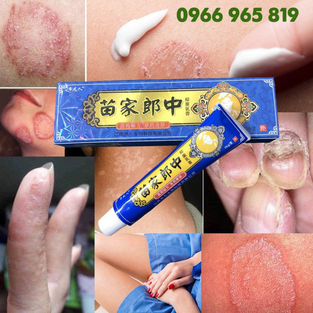 Kem bôi hắc lào, nấm ngứa, á sừng, lang ben hiệu quả 11