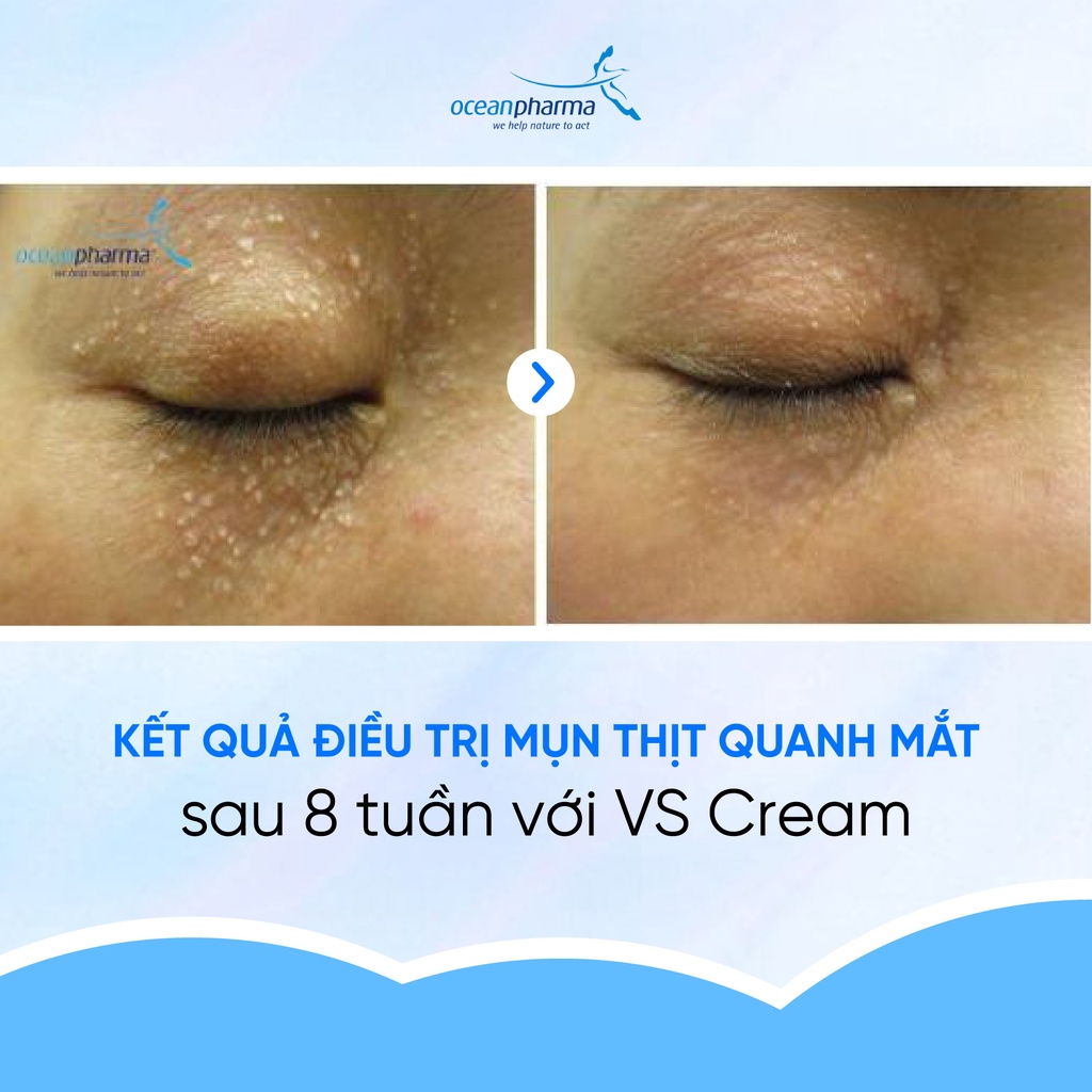 Kem dưỡng loại bỏ mụn Spirularin VS Cream Ocean Pharma Giảm mụn cóc mụn cơm HPV mào gà 15ml