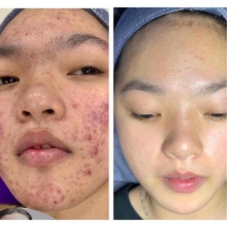 Huyết thanh đặc tri mụn đầu đen