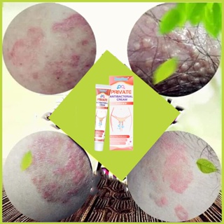 Kháng khuẩn vùng kín kem giảm ngứa kem chống chàm eczema giảm ngứa thảo - ảnh sản phẩm 4
