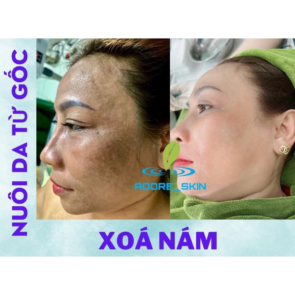 Bộ 3 sản phẩm loại bỏ nám không bong ADORE SKIN MELASMA
