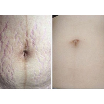 【💯Genuine Goods] QEM Stretch Marks Cream 100ml Prevention For Pregnant Women, Overcoming Stretch Marks