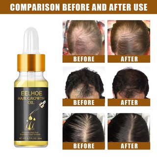 Tinh Dầu EELHOE Kích Thích Mọc Tóc Chống Rụng