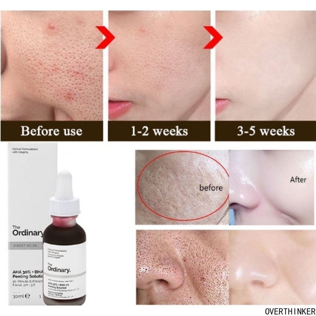 THE ORDINARY Hàng Có Sẵn Axit Salicylic 30% AH-A + B-HA 2% Chính Hãng Tinh Chất Tẩy Tế Bào Chết Toàn Thân 30ML