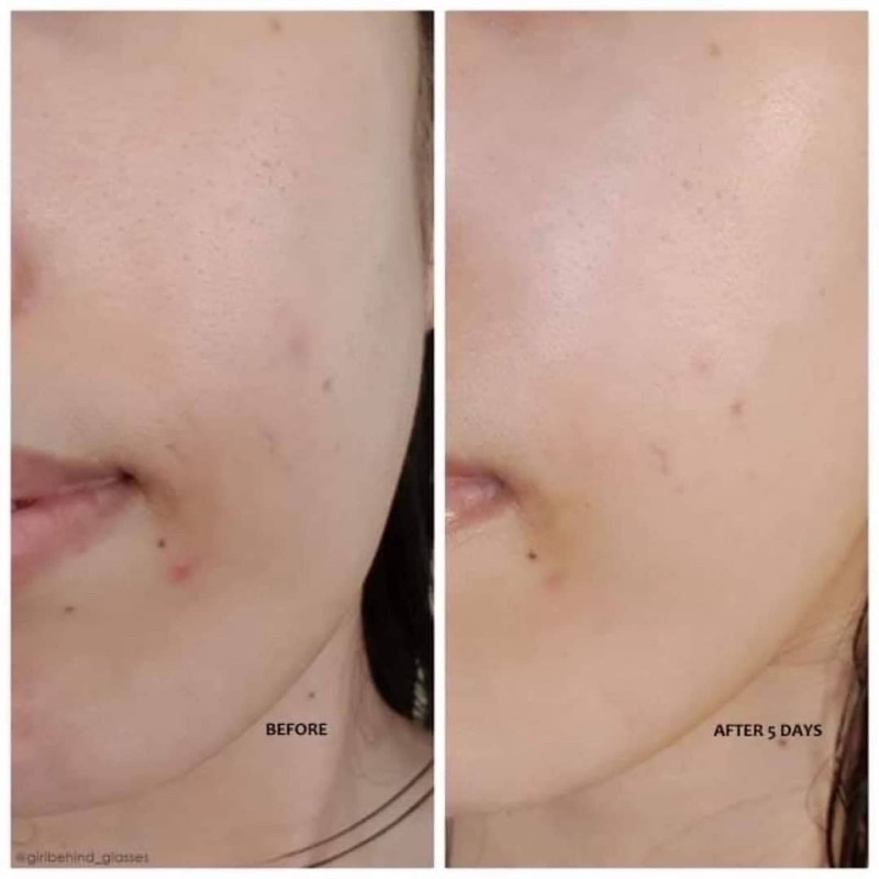 Tinh chất dưỡng sáng mờ thâm Derma Factory Niacinamide 20%