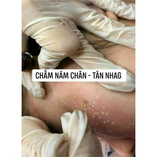 tca chấm nám tàn nhang